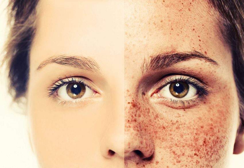 Best Skin Doctor for Removing Freckles in Faridabad