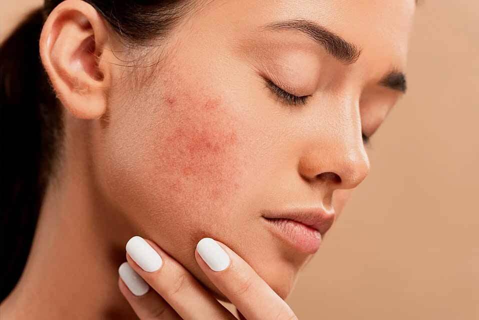 Acne Scars Specialist in Faridabad