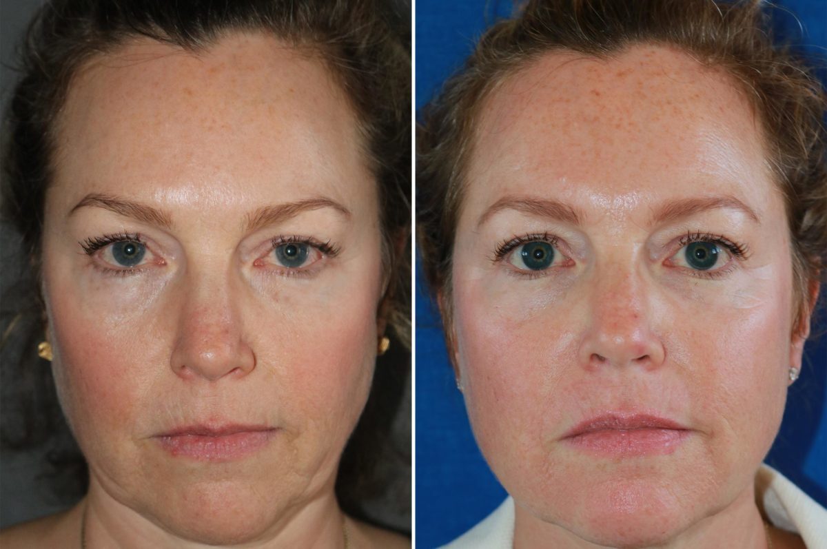 Best Dermatologist for Face Lifting in Faridabad