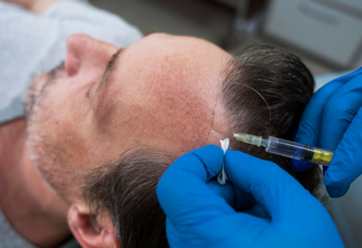 Acne Scars Specialist in Faridabad
