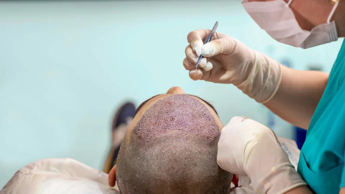 Dermatologist for Hair transplant in Faridabad 