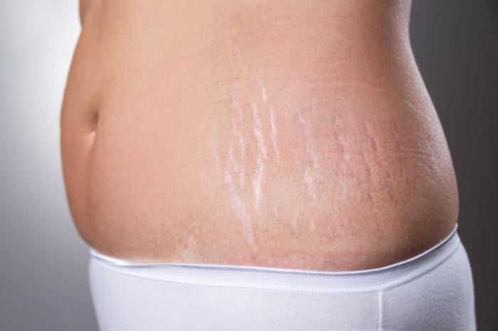 Dermatologist for Removal of Stretch Marks in Faridabad