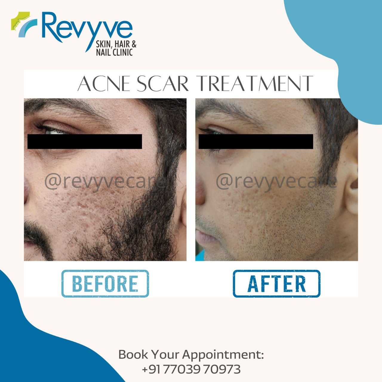 Best Acne Scars Treatment Skin Specialist in Faridabad