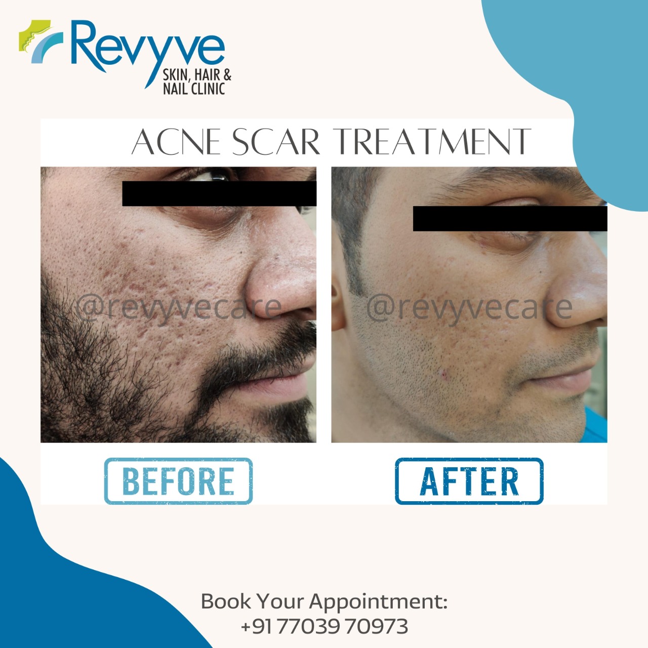Acne Scars Specialist in Faridabad