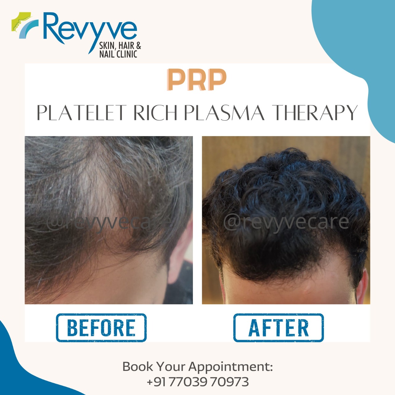 Hair Transplant Cost in Faridabad  Get Best Price